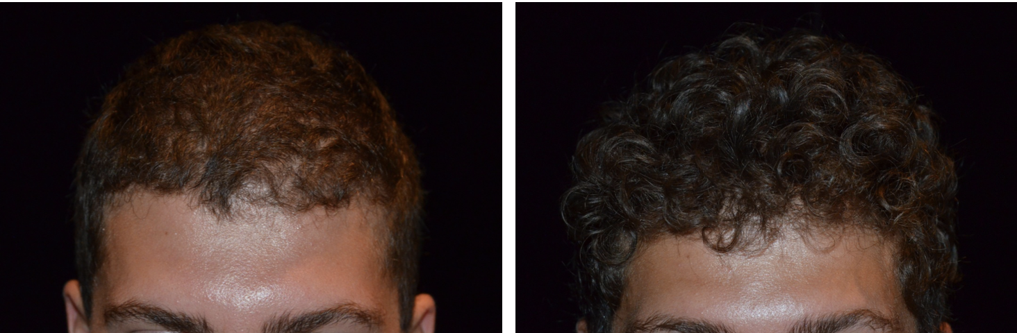 Hair Restoration Treatment  Hair Loss Thinning Hair Balding  Pittsburgh  Monroeville Penn Hills Plum
