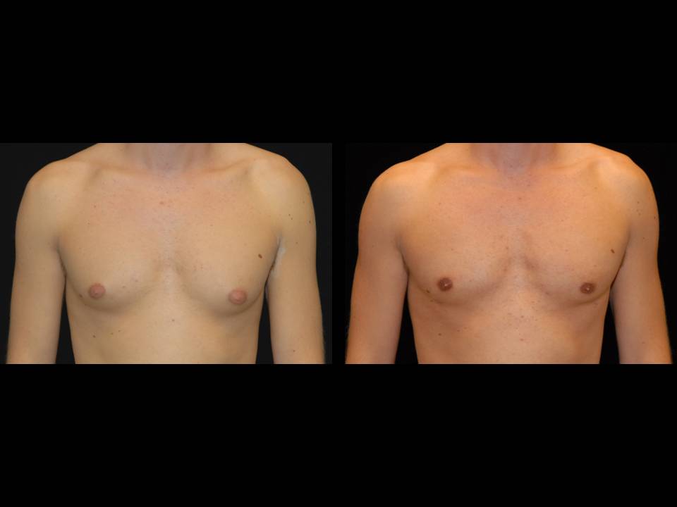 Gynecomastia Before and After | Premier Plastic Surgery