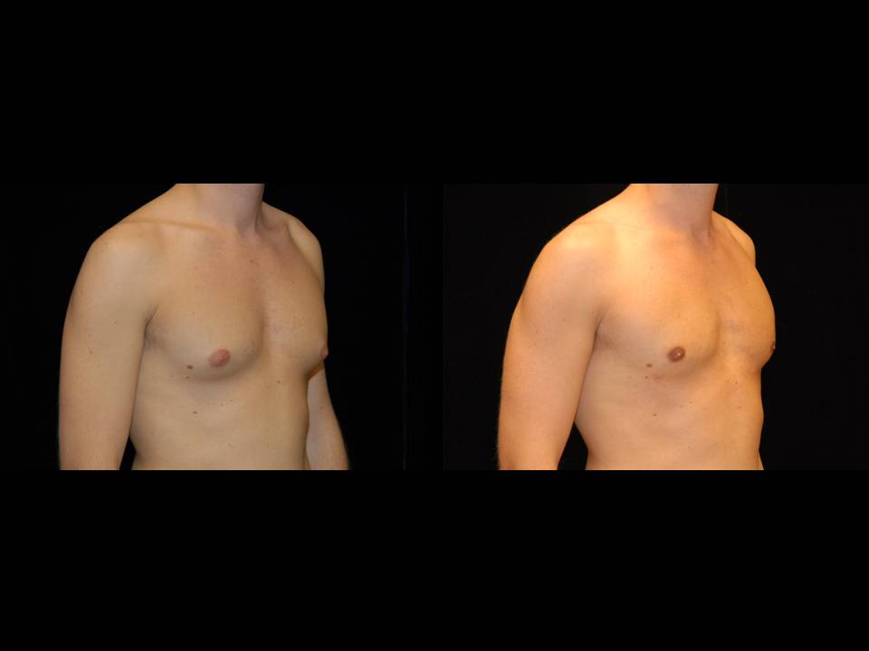 Gynecomastia Before and After | Premier Plastic Surgery