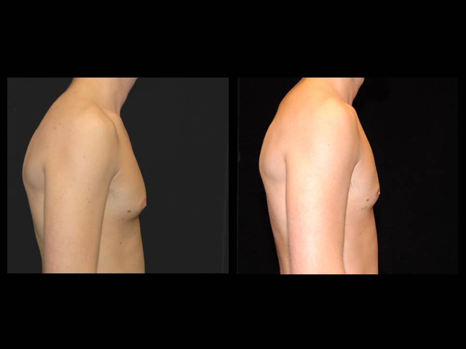 Gynecomastia Before and After | Premier Plastic Surgery