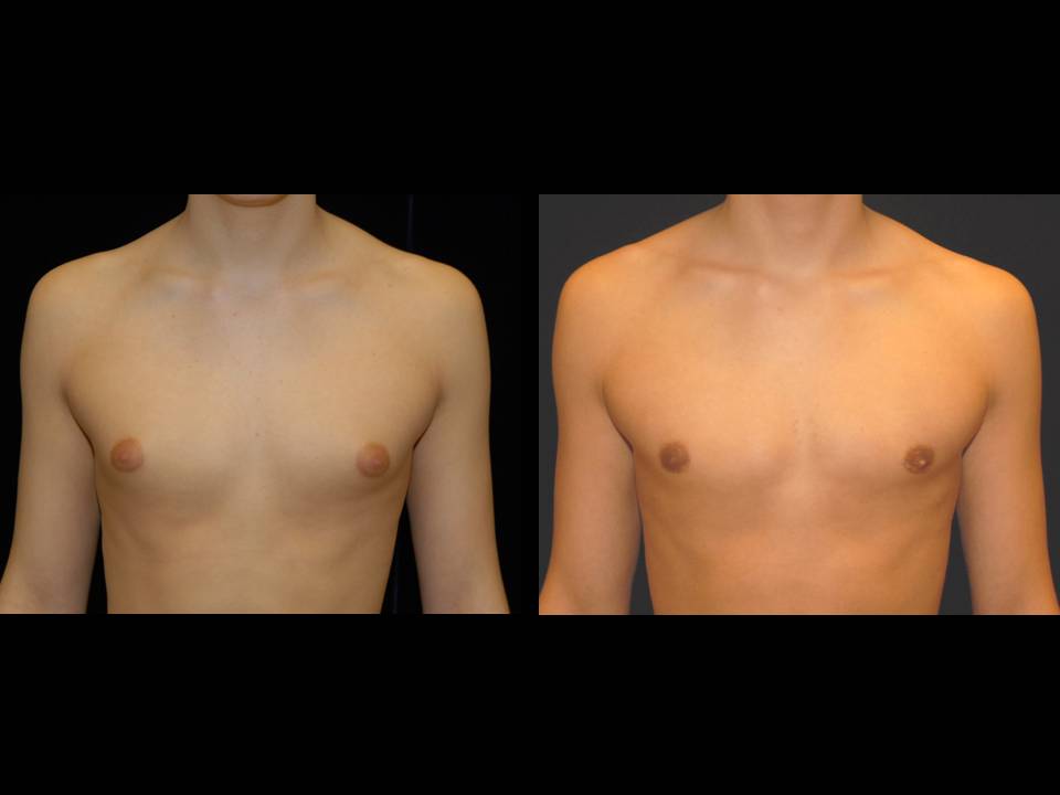 Gynecomastia Before and After | Premier Plastic Surgery