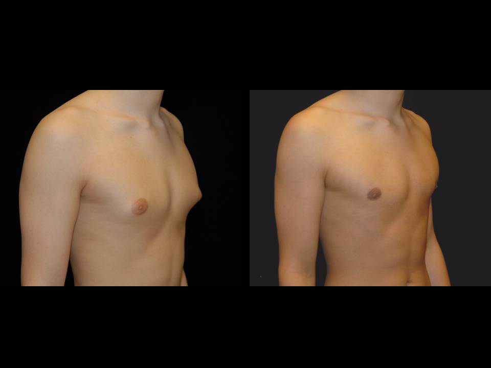 Gynecomastia Before and After | Premier Plastic Surgery