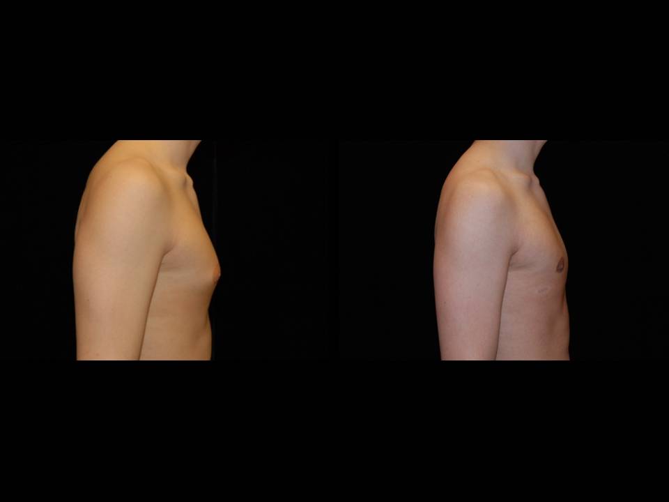 Gynecomastia Before and After | Premier Plastic Surgery