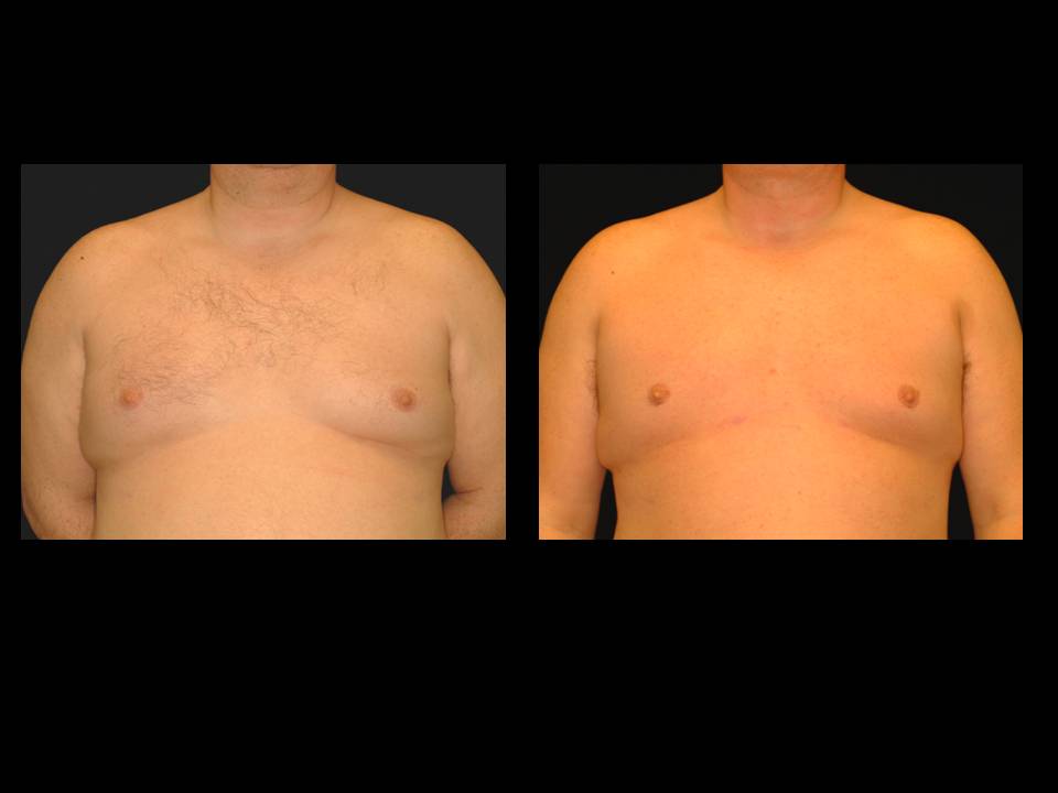 Gynecomastia Before and After | Premier Plastic Surgery