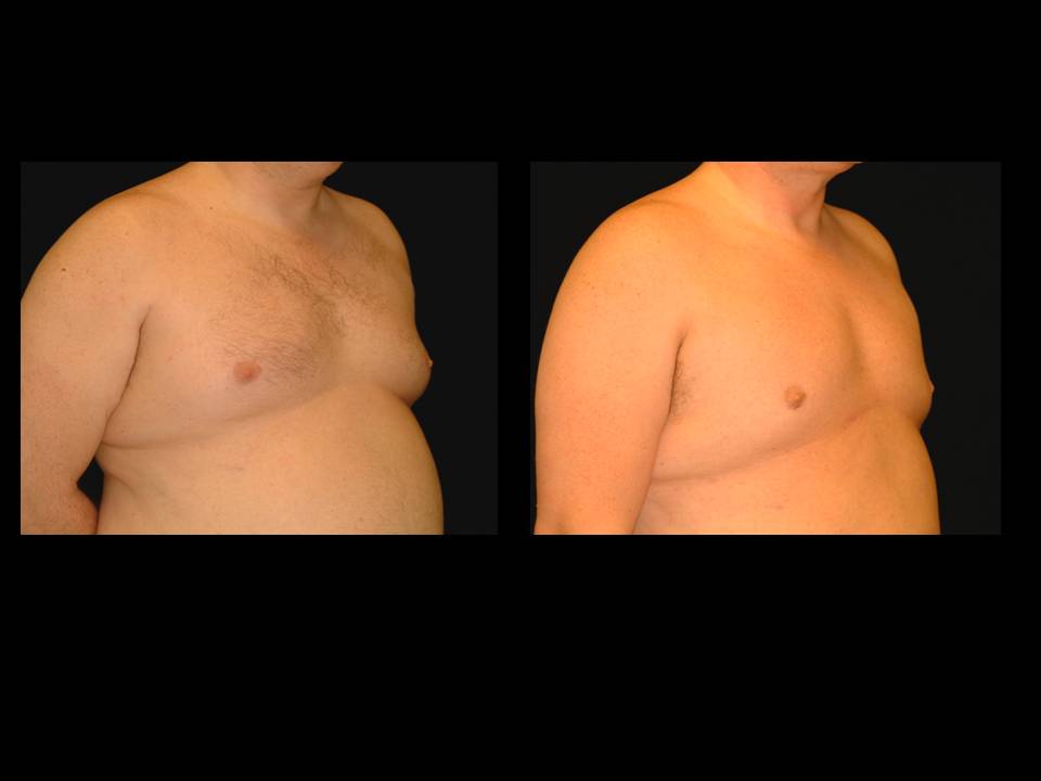 Gynecomastia Before and After | Premier Plastic Surgery