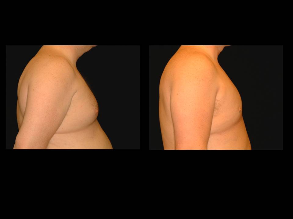 Gynecomastia Before and After | Premier Plastic Surgery