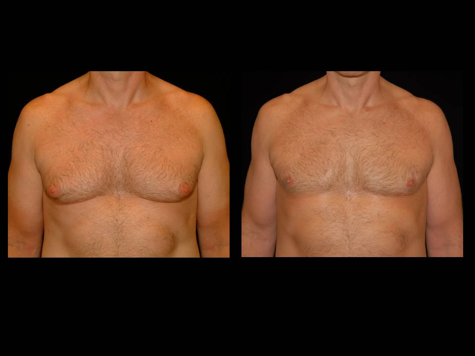 Gynecomastia Before and After | Premier Plastic Surgery