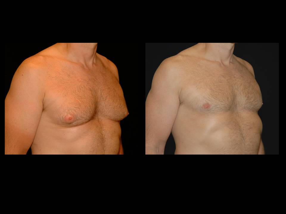 Gynecomastia Before and After | Premier Plastic Surgery