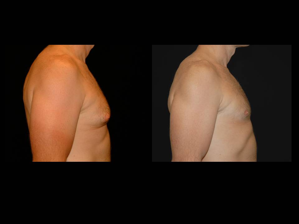 Gynecomastia Before and After | Premier Plastic Surgery