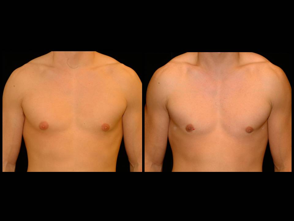 Gynecomastia Before and After | Premier Plastic Surgery