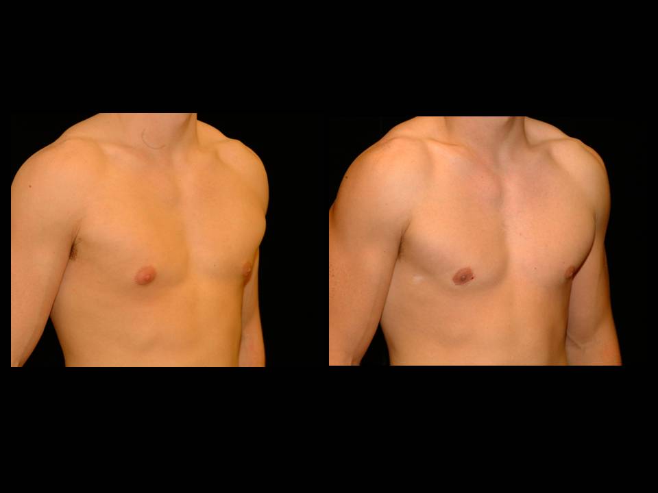 Gynecomastia Before and After | Premier Plastic Surgery