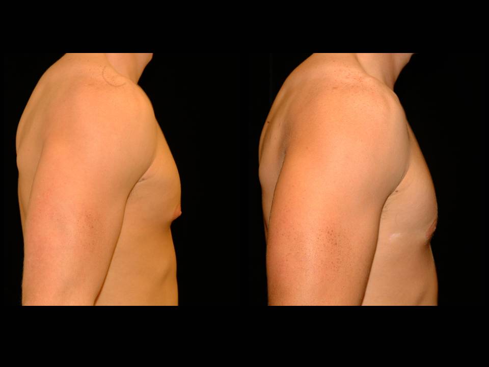 Gynecomastia Before and After | Premier Plastic Surgery