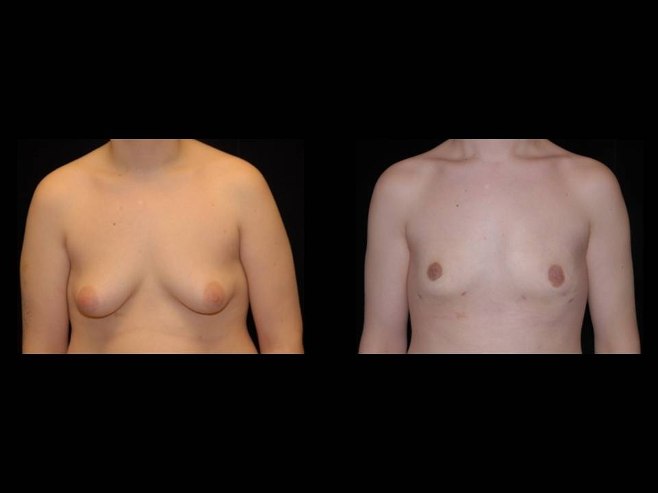 Gynecomastia Before and After | Premier Plastic Surgery