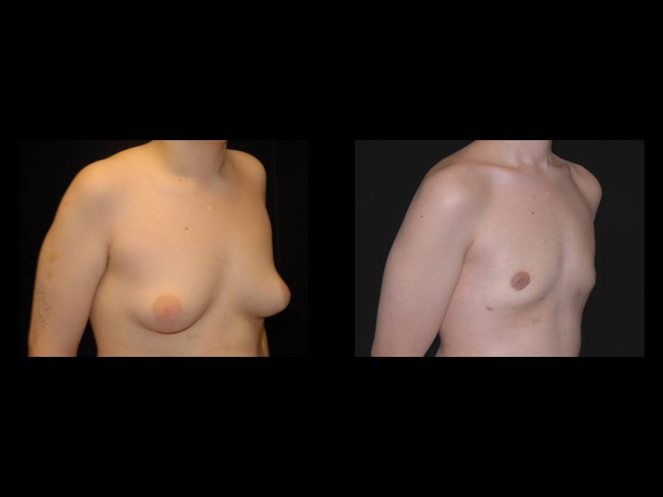 Gynecomastia Before and After | Premier Plastic Surgery