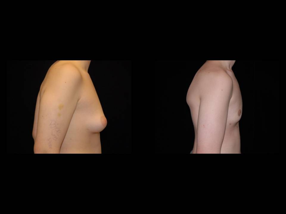 Gynecomastia Before and After | Premier Plastic Surgery