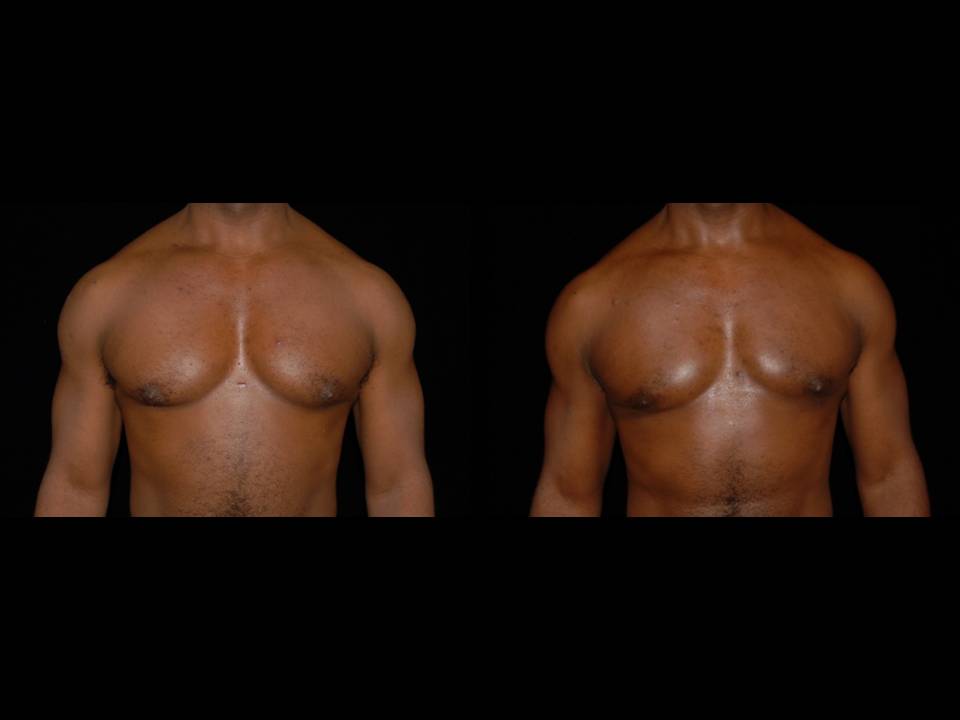 Gynecomastia Before and After | Premier Plastic Surgery