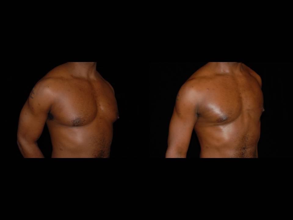 Gynecomastia Before and After | Premier Plastic Surgery