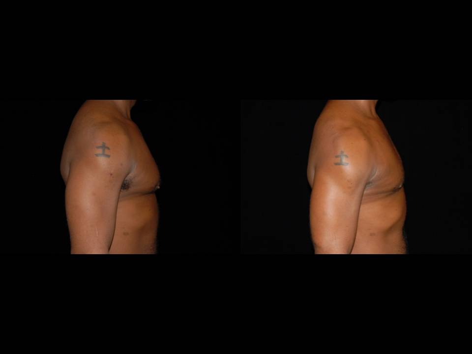 Gynecomastia Before and After | Premier Plastic Surgery