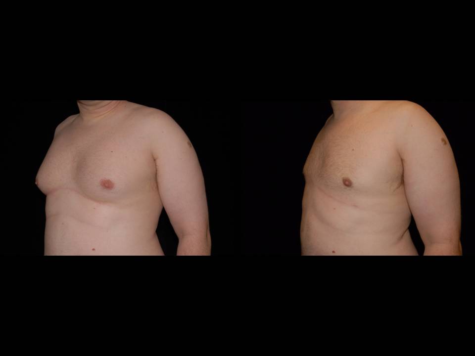 Gynecomastia Before and After | Premier Plastic Surgery