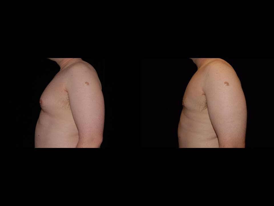 Gynecomastia Before and After | Premier Plastic Surgery