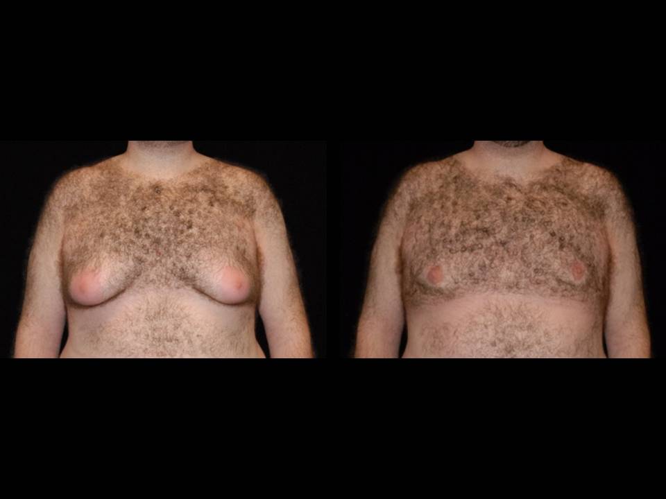 Gynecomastia Before and After | Premier Plastic Surgery