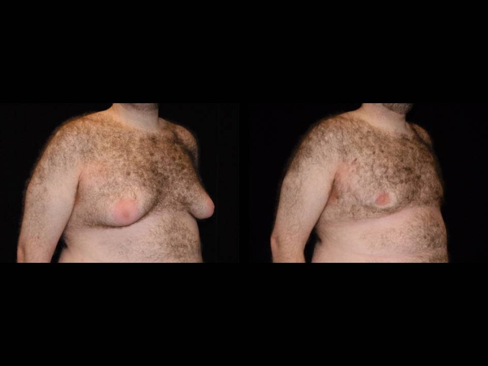 Gynecomastia Before and After | Premier Plastic Surgery