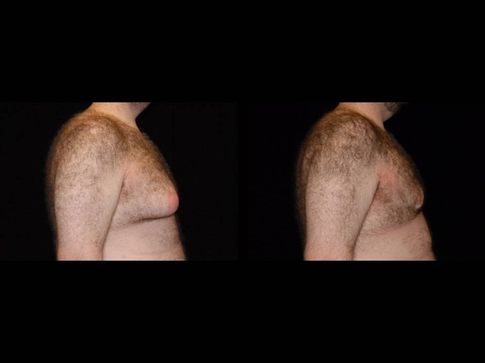 Gynecomastia Before and After | Premier Plastic Surgery