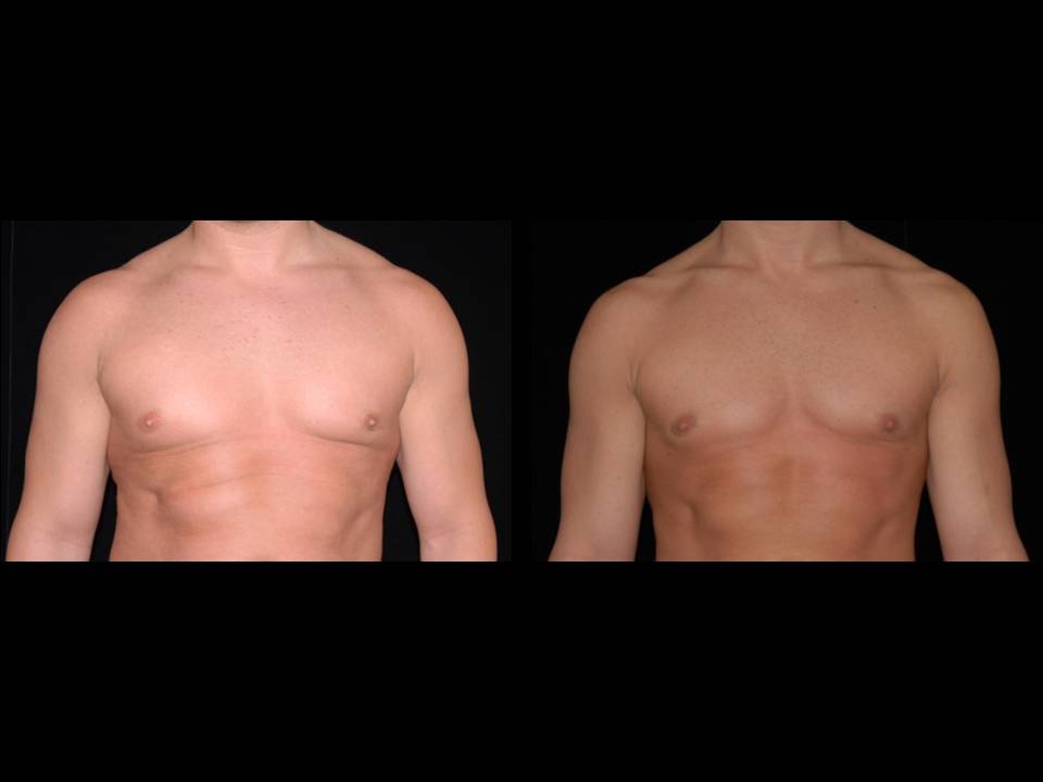 Gynecomastia Before and After | Premier Plastic Surgery