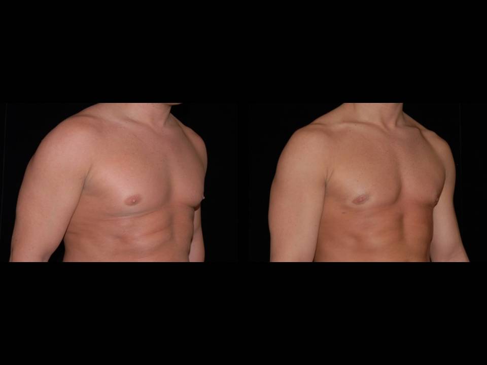 Gynecomastia Before and After | Premier Plastic Surgery