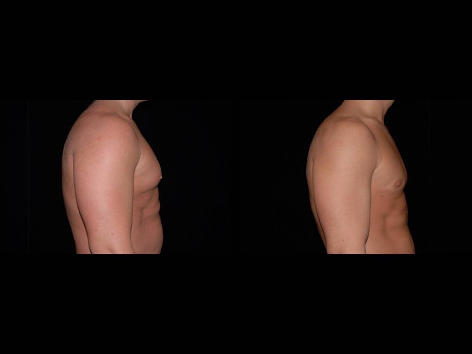 Gynecomastia Before and After | Premier Plastic Surgery