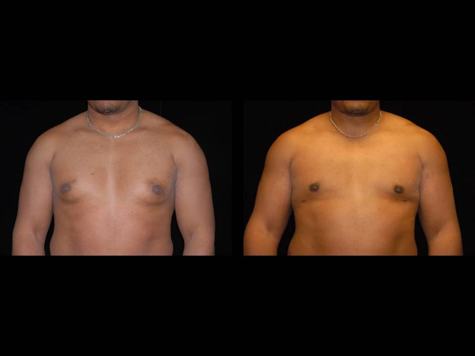 Gynecomastia Before and After | Premier Plastic Surgery