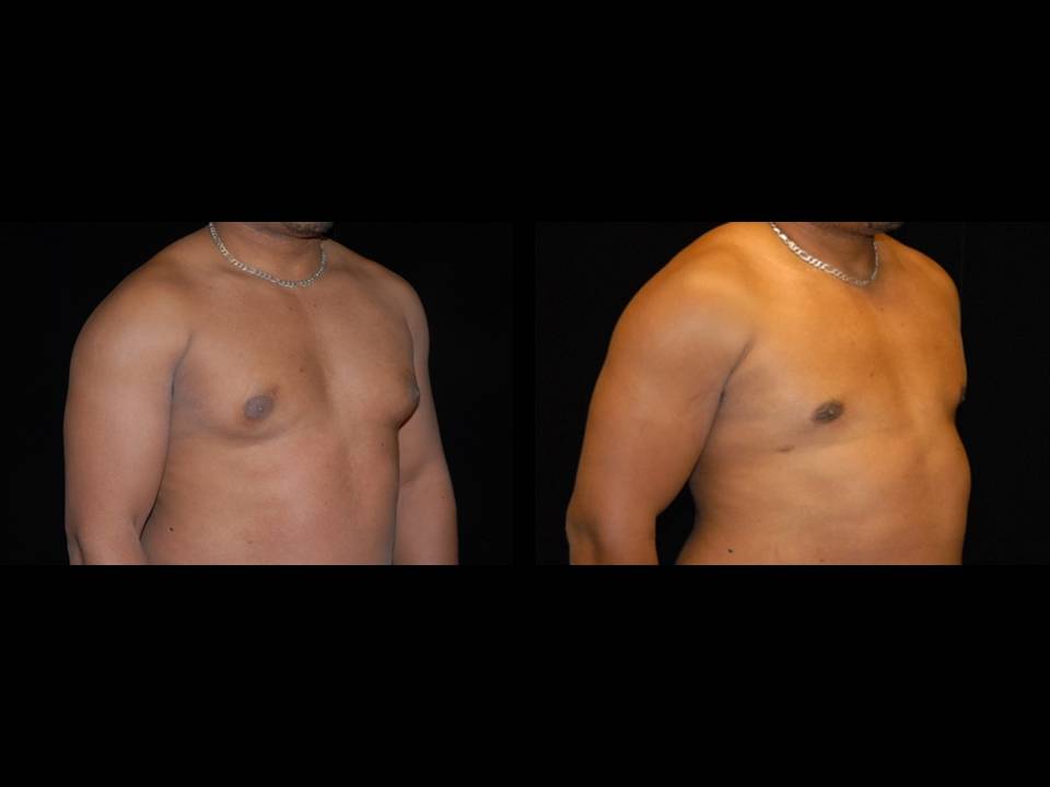 Gynecomastia Before and After | Premier Plastic Surgery