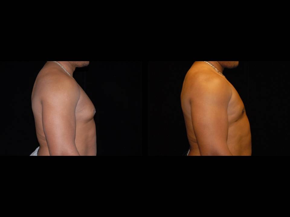 Gynecomastia Before and After | Premier Plastic Surgery