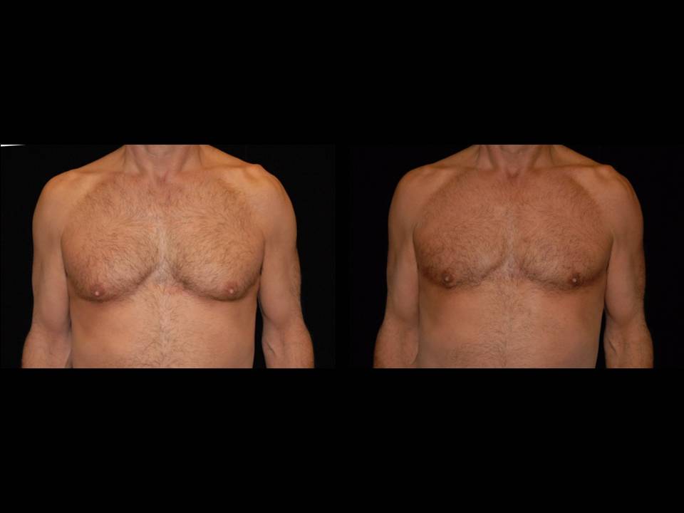 Gynecomastia Before and After | Premier Plastic Surgery