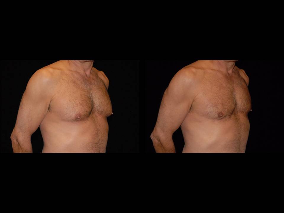 Gynecomastia Before and After | Premier Plastic Surgery