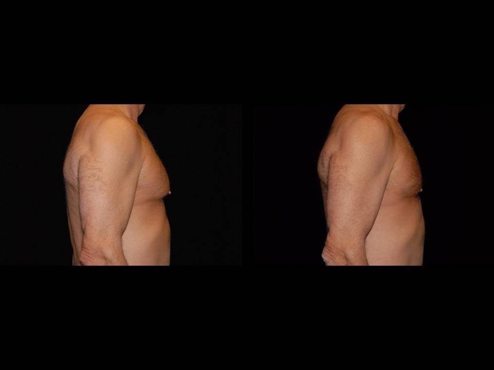 Gynecomastia Before and After | Premier Plastic Surgery