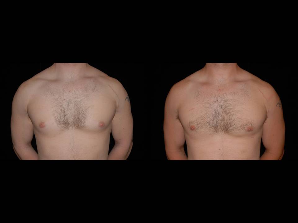 Gynecomastia Before and After | Premier Plastic Surgery