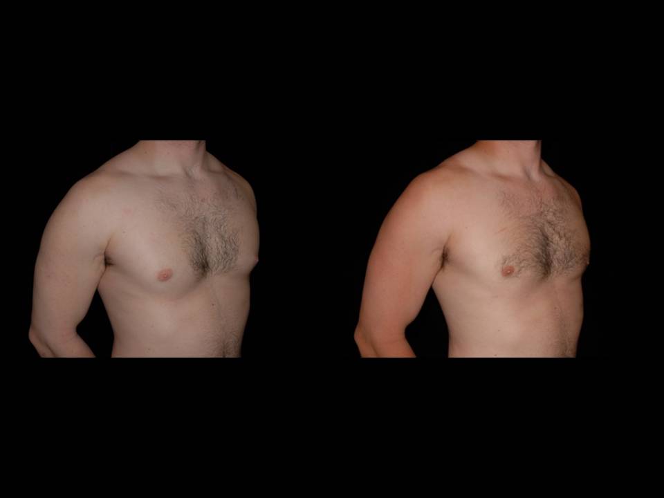 Gynecomastia Before and After | Premier Plastic Surgery