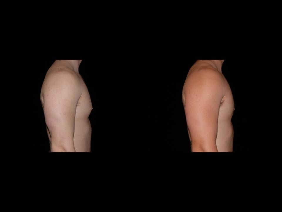 Gynecomastia Before and After | Premier Plastic Surgery