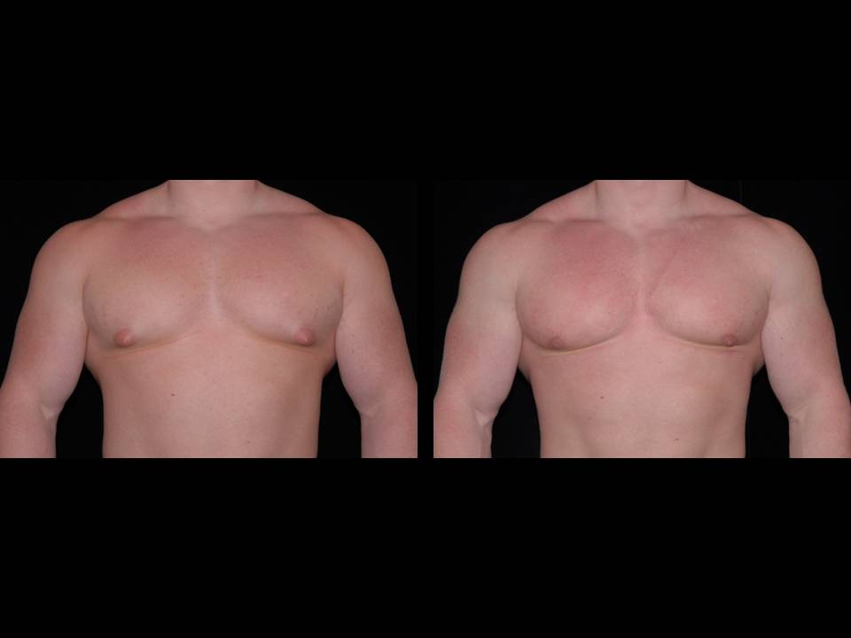 Gynecomastia Before and After | Premier Plastic Surgery