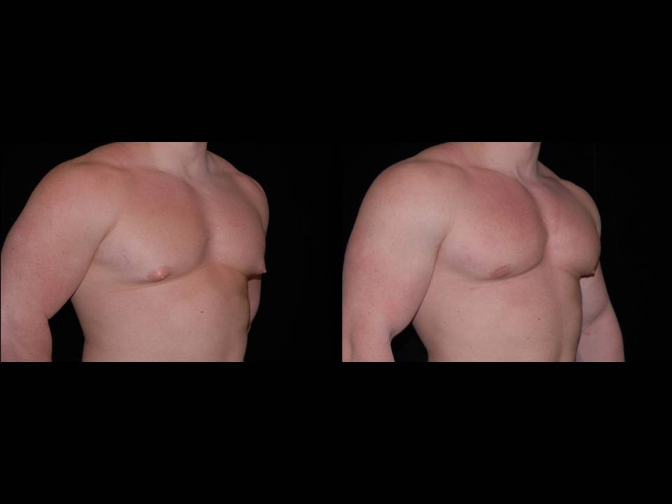 Gynecomastia Before and After | Premier Plastic Surgery