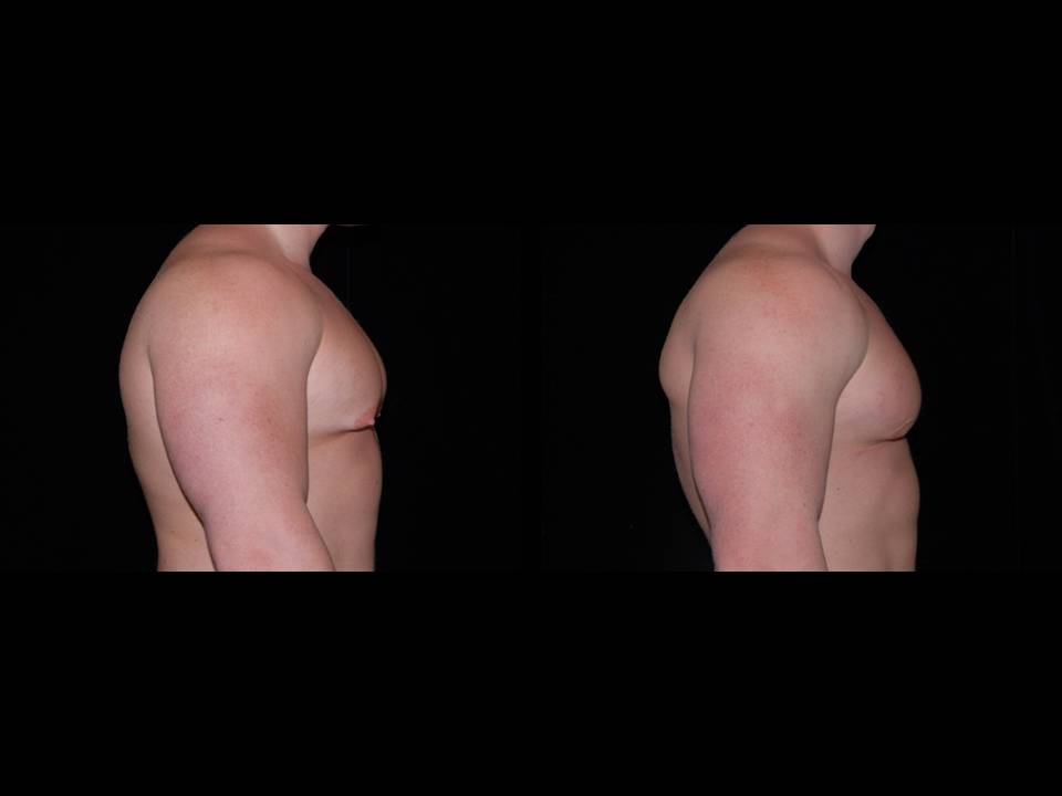 Gynecomastia Before and After | Premier Plastic Surgery