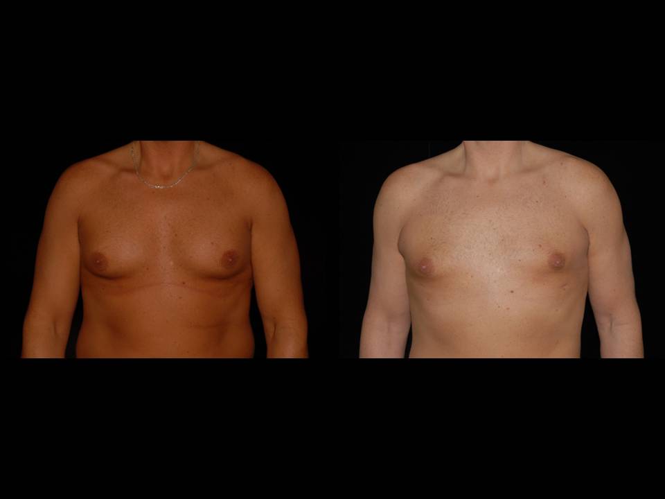 Gynecomastia Before and After | Premier Plastic Surgery