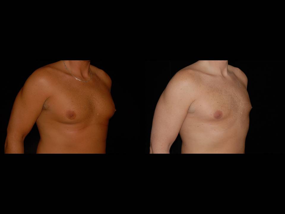 Gynecomastia Before and After | Premier Plastic Surgery