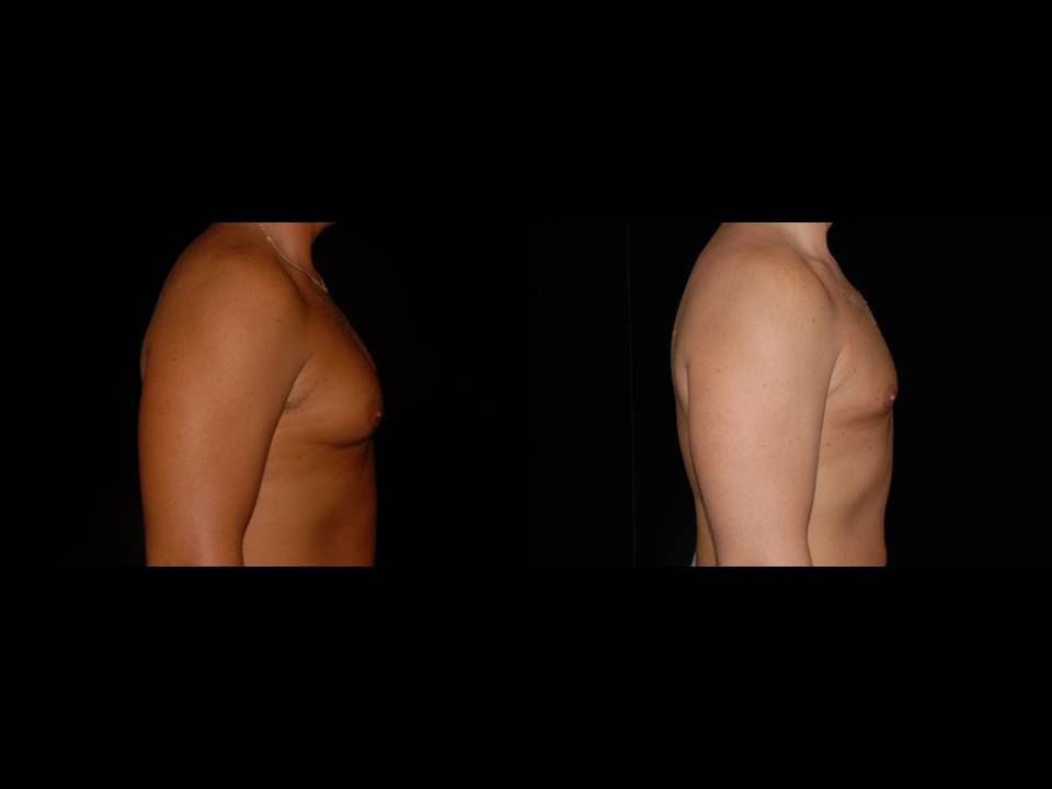 Gynecomastia Before and After | Premier Plastic Surgery