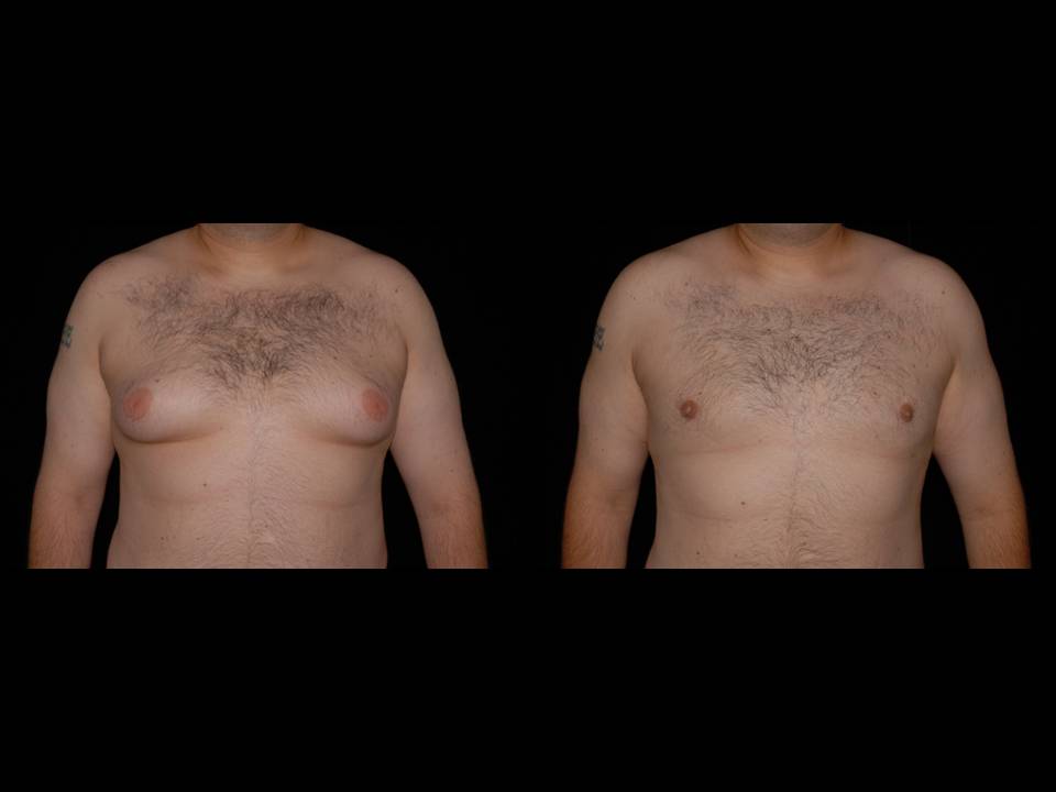 Gynecomastia Before and After | Premier Plastic Surgery