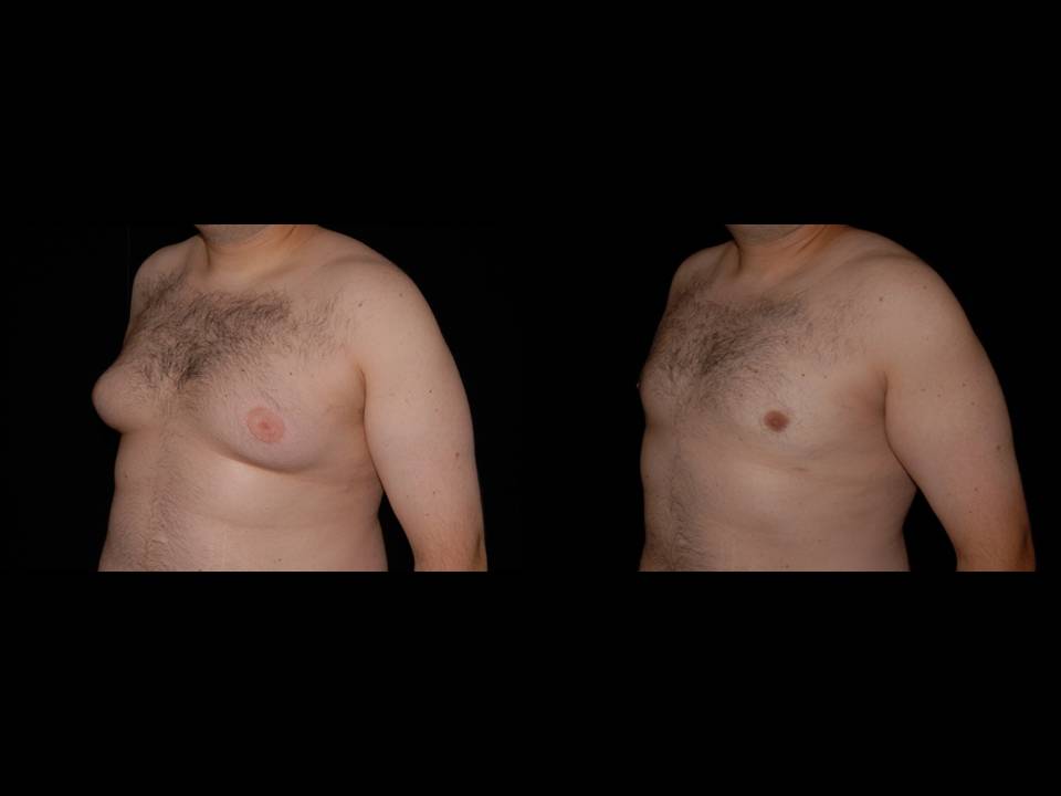 Gynecomastia Before and After | Premier Plastic Surgery