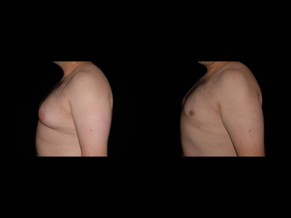 Gynecomastia Before and After | Premier Plastic Surgery