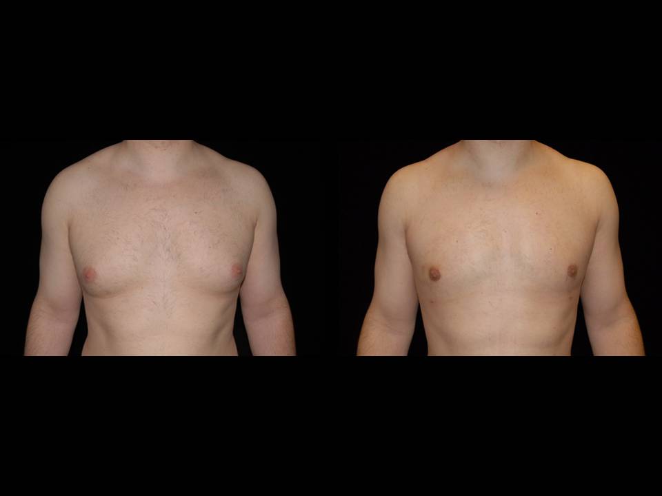 Gynecomastia Before and After | Premier Plastic Surgery