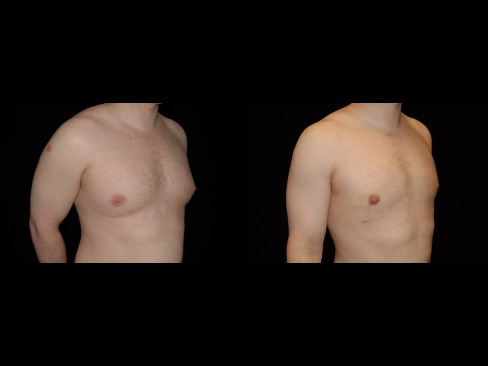 Gynecomastia Before and After | Premier Plastic Surgery